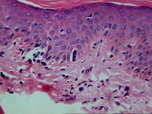 Fig.10. Linfocitos atípicos dentro de la epidermis - <div style=